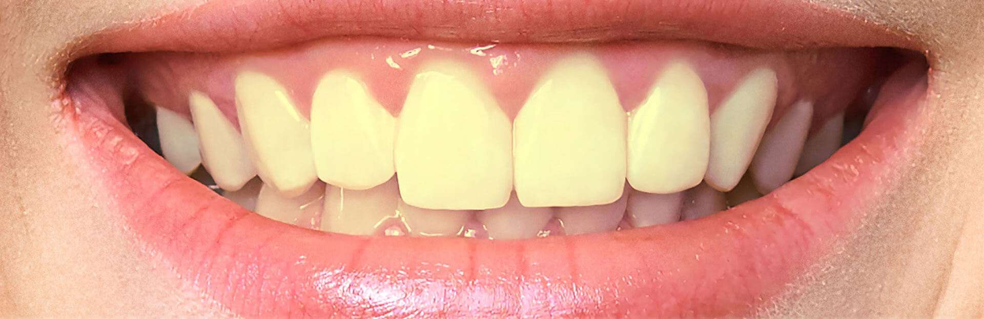 teeth-before-after--compressed