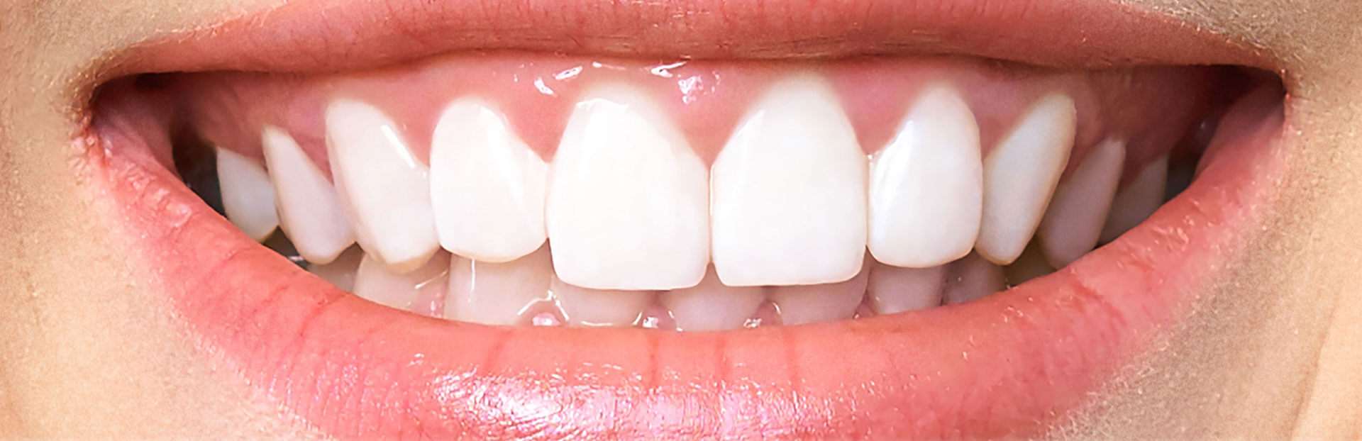 teeth-before-after-whitening-compressed