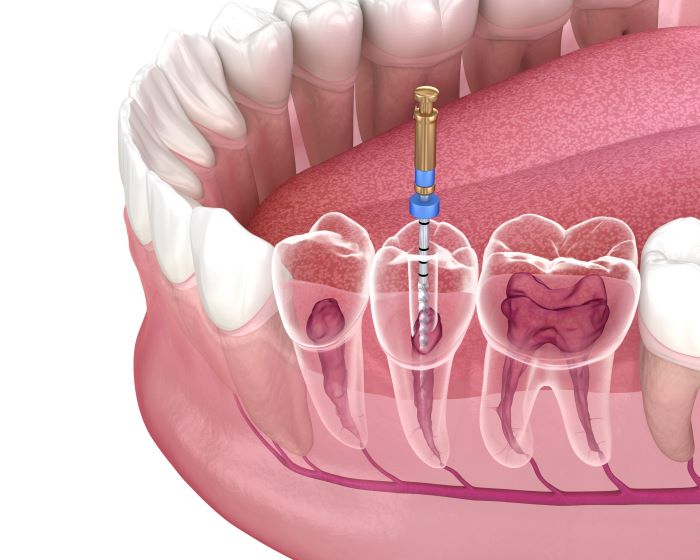 Best Root Canal Treatment in Hyderabad